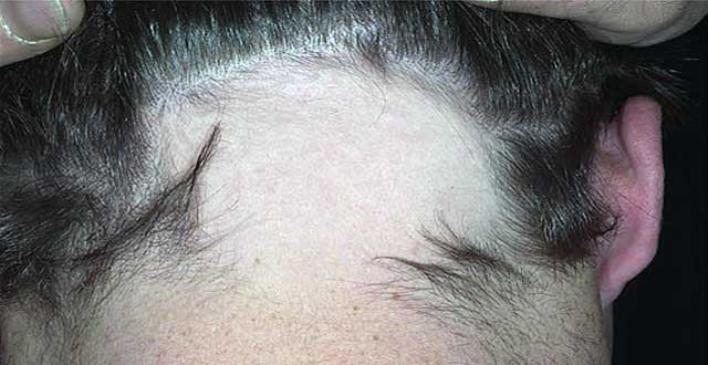 Alopecia areata cabello