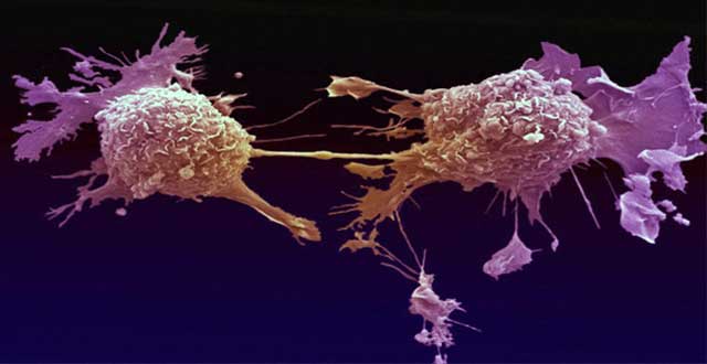 Cancer epitelial celulas madre