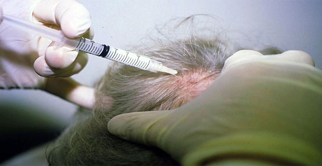 Alopecia tratamiento