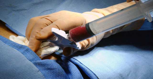 Trasplante medula VIH
