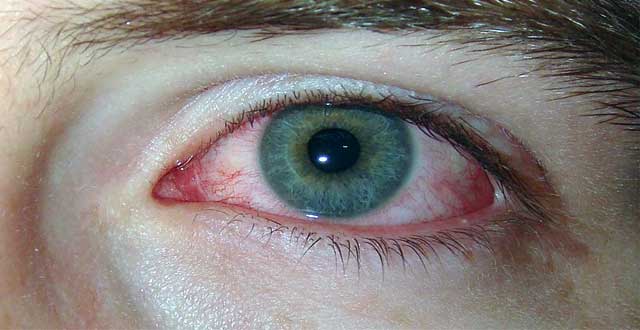 Sintomas resequedad ocular